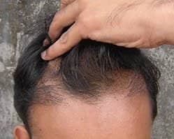 Slider image (6) AEK Hair Institute